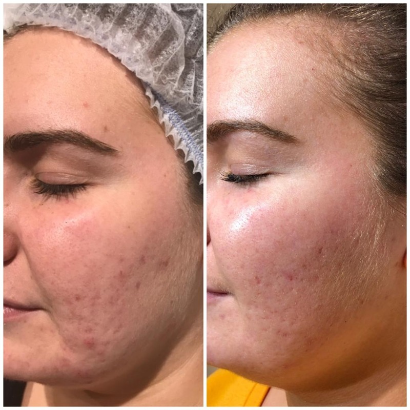 Microneedling Microneedling